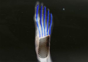 Teeter Totter : l'effet qui ferait avancer les super shoes avec une plaque carbone 10